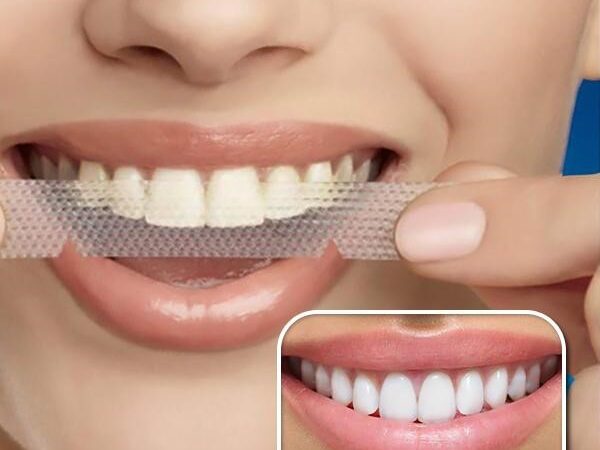 Tips to Prepare for Dental Whitening with Crest Whitestrips
