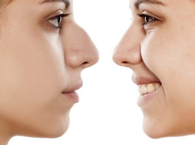 Tips To Prepare For Nose Reshaping Surgery