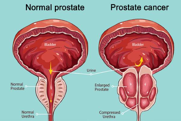 What Everyone Must Know About Symptoms of Prostate Cancer?