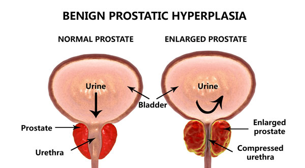 What is Benign Prostatic Hyperplasia?