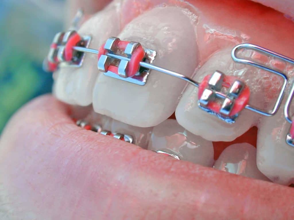The Novice’s Guide To Conventional Braces Taking Care Of Oral Hygiene