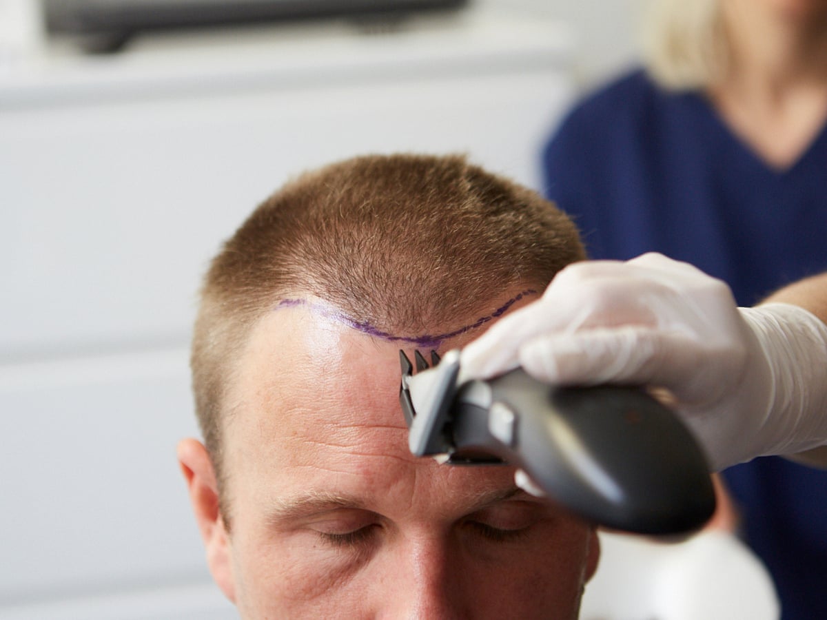 The journey from bald to bold with hair transplant surgery