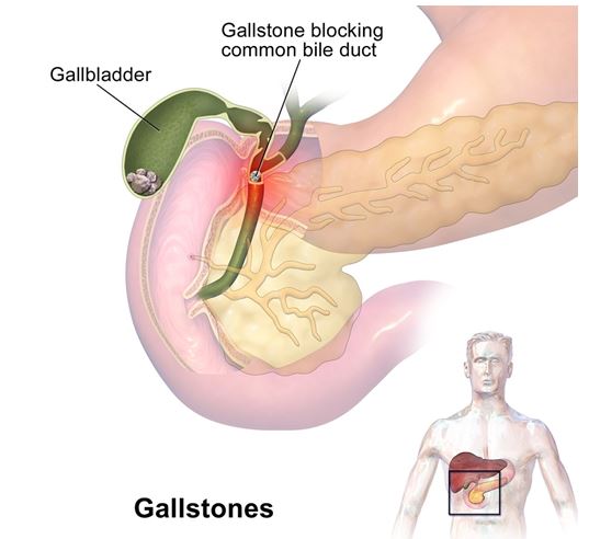 Gallstones and Surgery in the Gallbladder